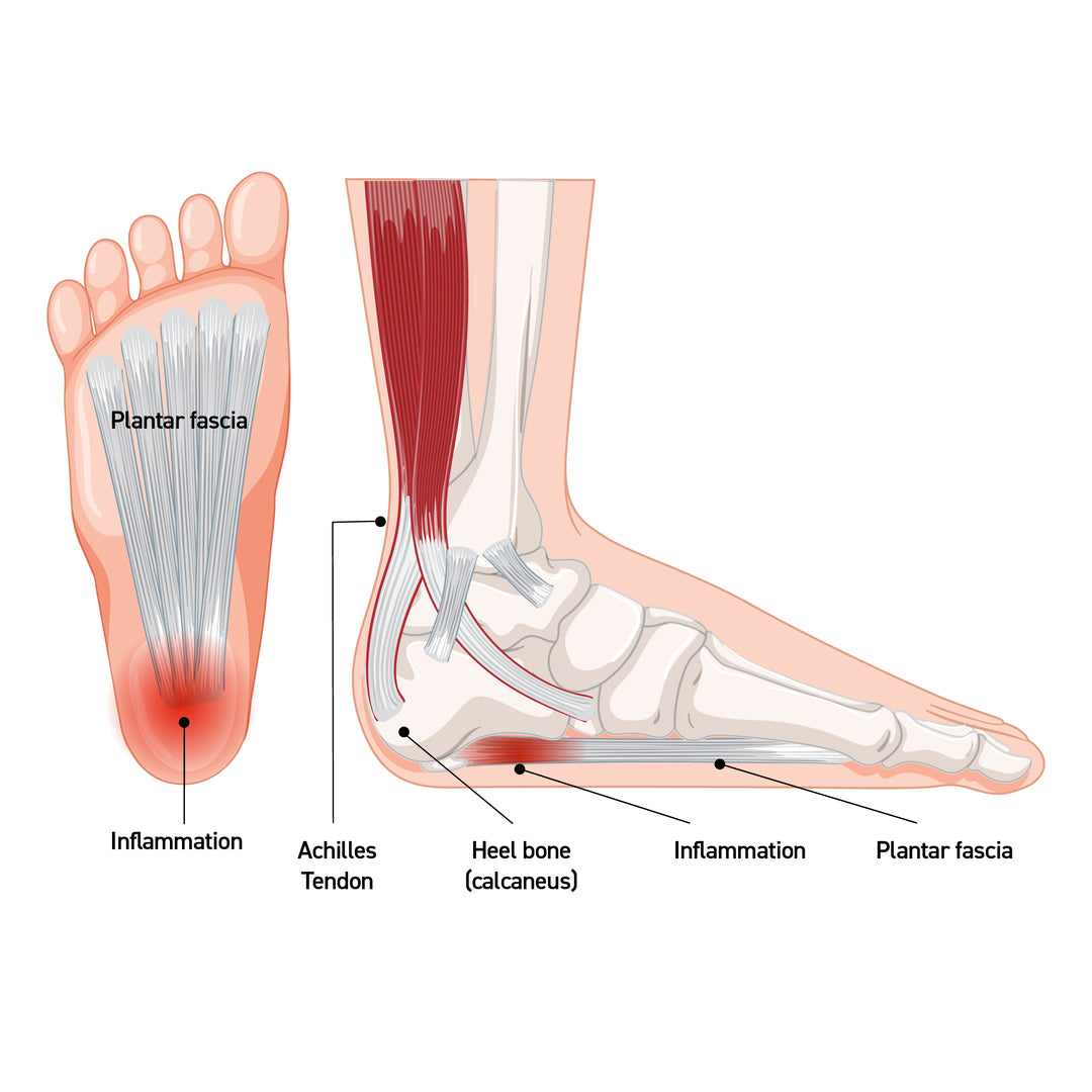 Plantar Fasciitis Tendonitis Sole Of Foot Tendon Plantar Surface Of